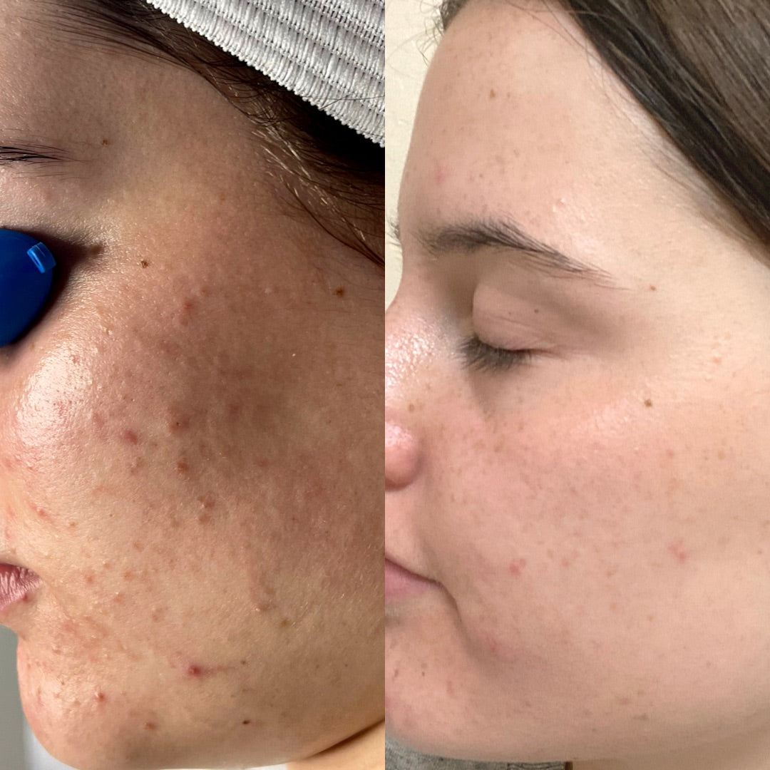 5 weeks of acne clearing bootcamp
