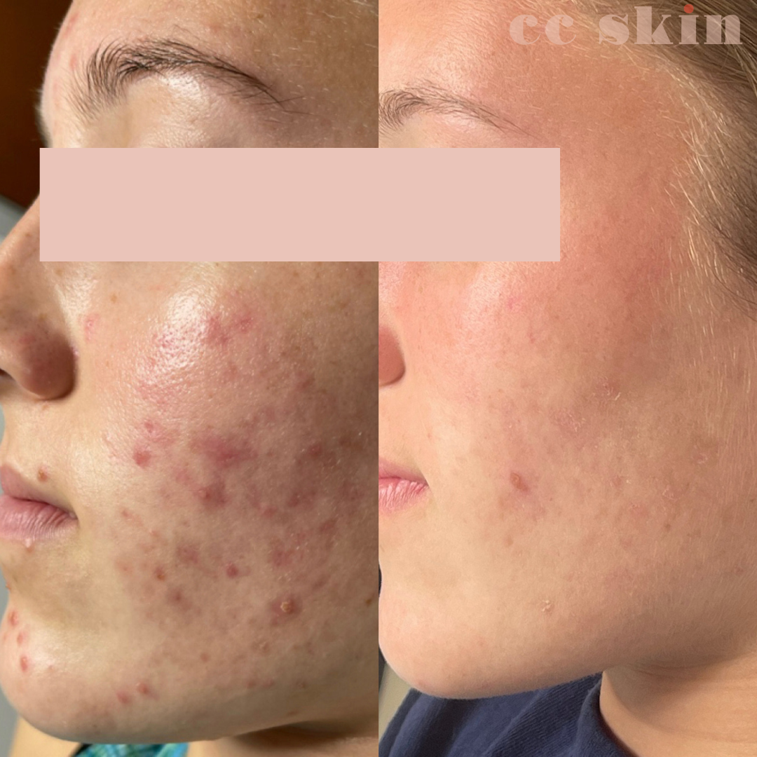 Acne Treatment before and after pictures