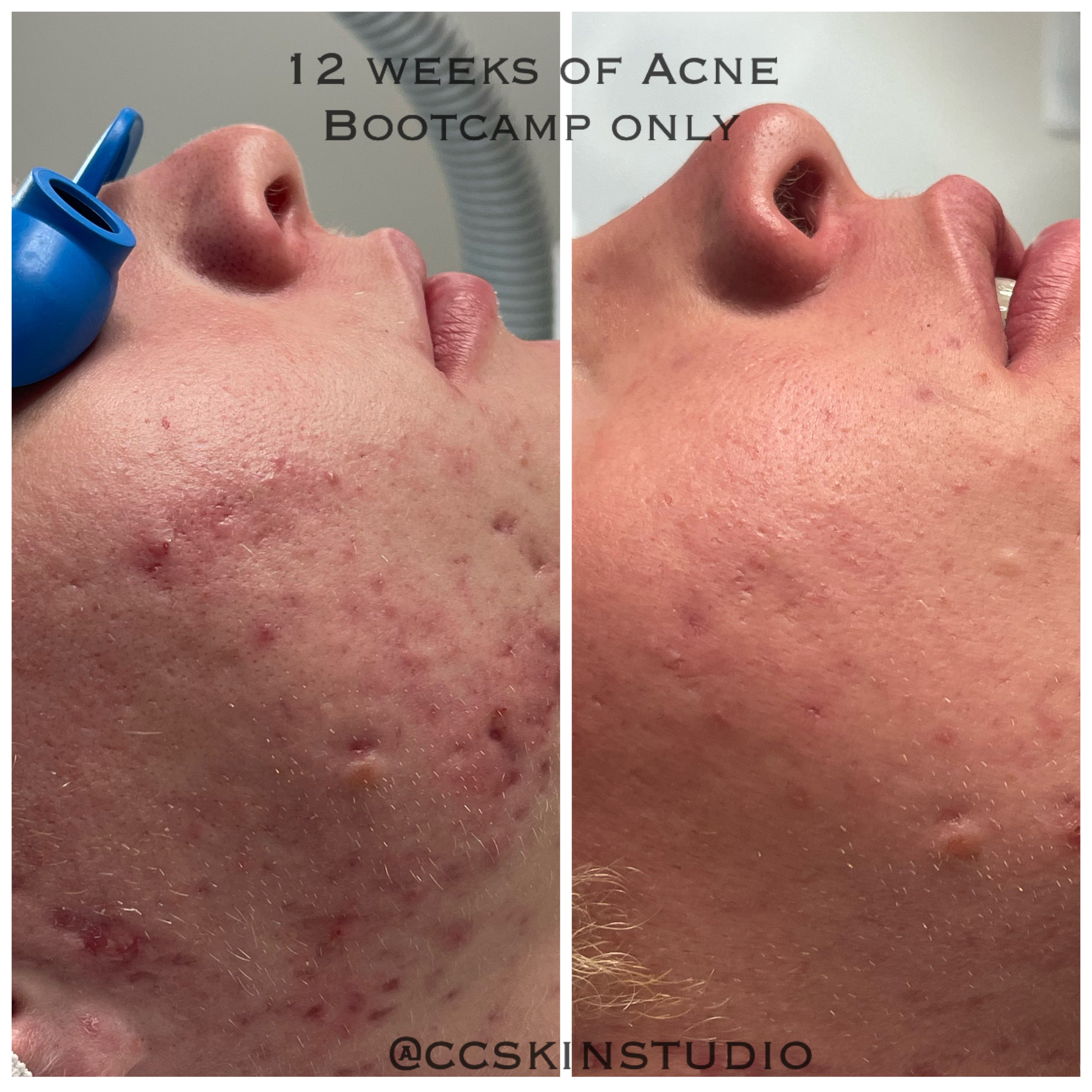 12 weeks of Acne Bootcamp alone, client has not undergone any acne scar revision 