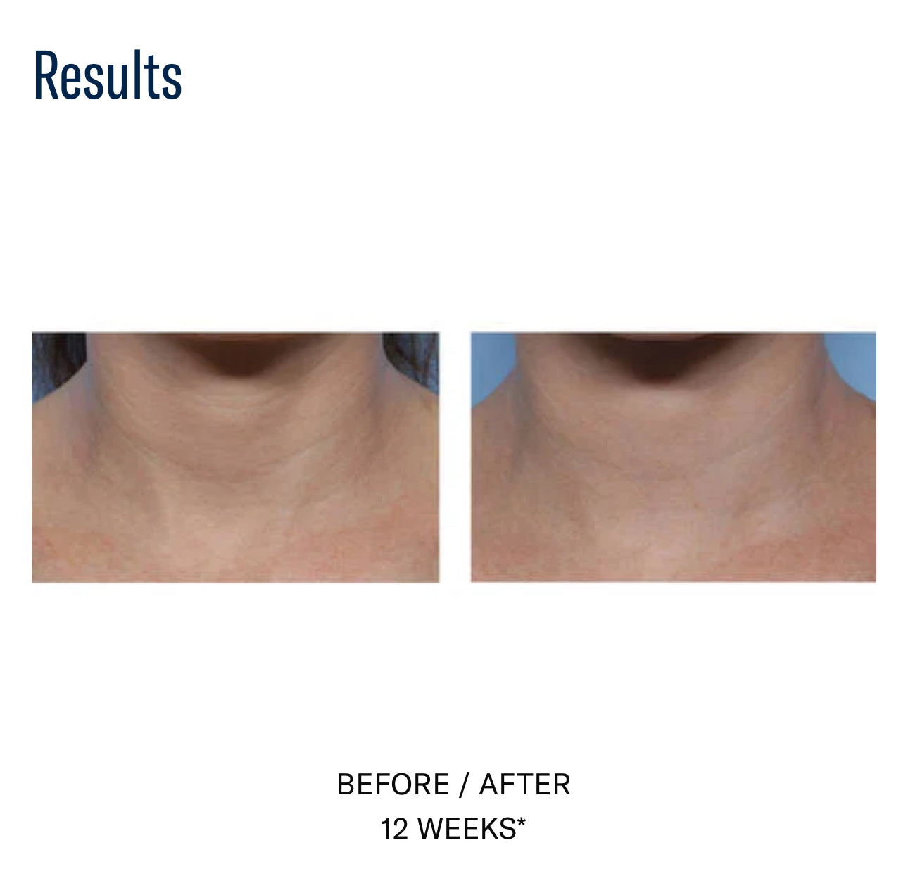 Techno Neck Perfecting Cream