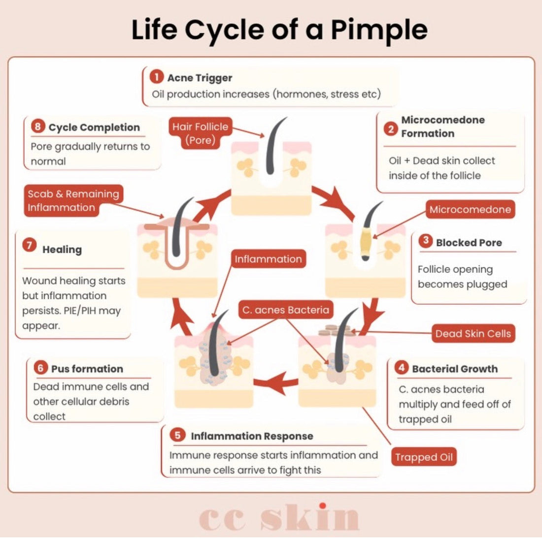 Life cycle of a pimple acne stages facial treatment Gilbert AZ