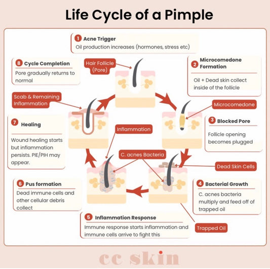 Life cycle of a pimple acne stages facial treatment Gilbert AZ