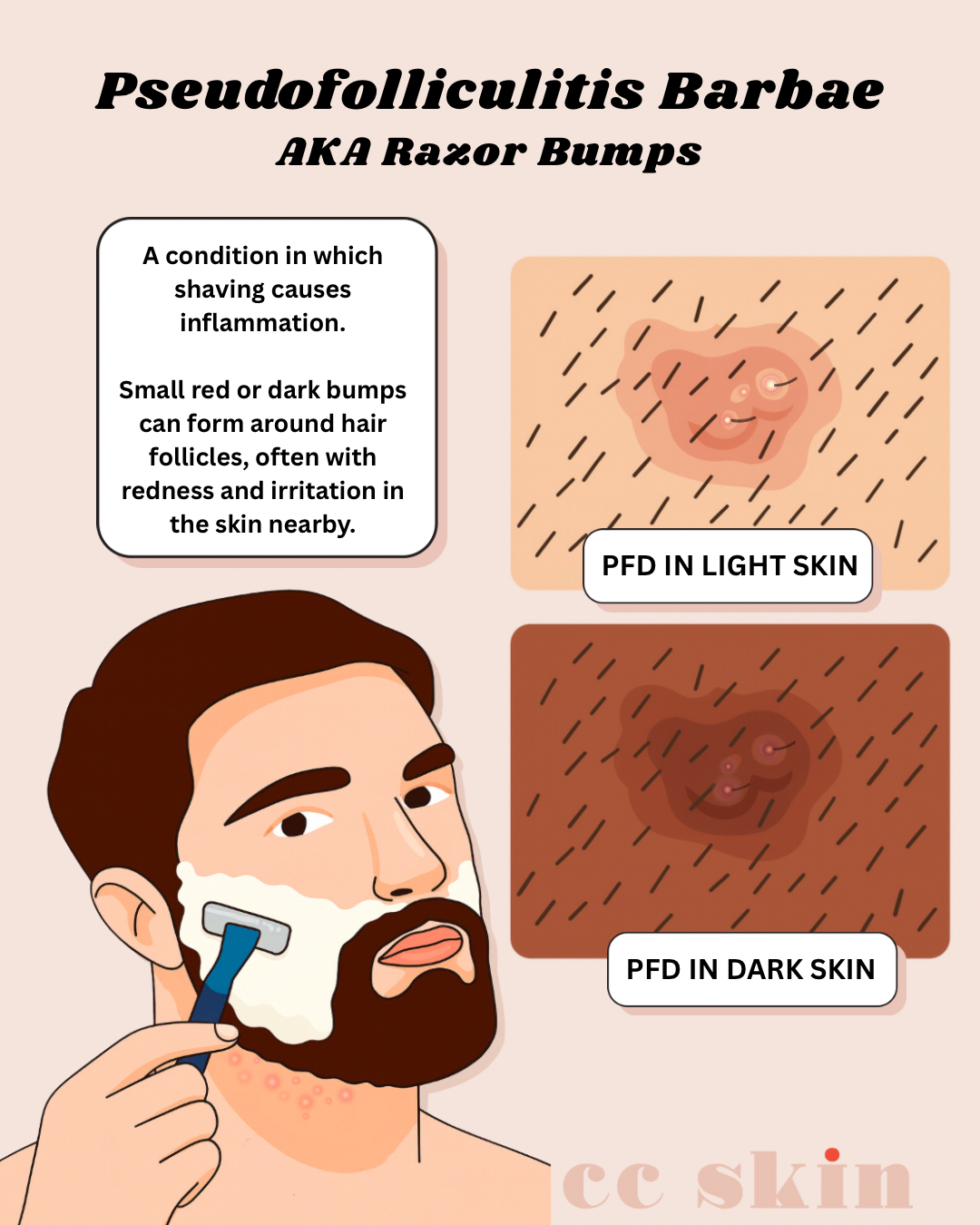 How to Manage and Prevent Razor Bumps (Pseudofolliculitis Barbae)