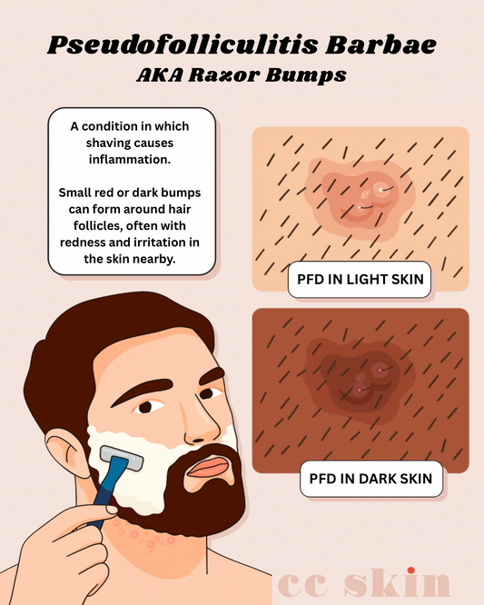 How to Manage and Prevent Razor Bumps (Pseudofolliculitis Barbae)