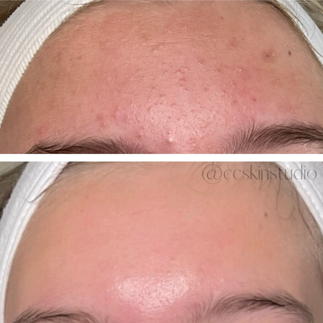 Acne skin Mesa acne facials acne peels